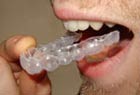 Tooth whiteners can be applied to teeth using custom made mouthguards