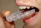 Los productos blanqueadores pueden aplicarse mediante fundas
								dentales