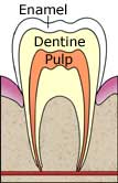 According to most studies, tooth whitening does not harm the enamel