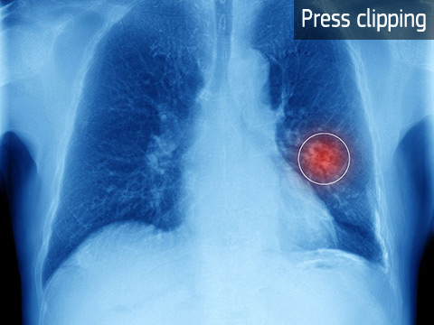 Irish study offers promise for chemo resistant lung cancer patients